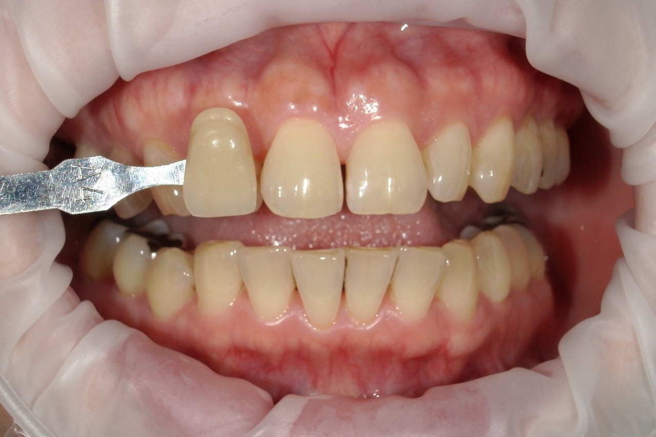 浜松市中央区・自動車学校前駅のホワイトニングの症例