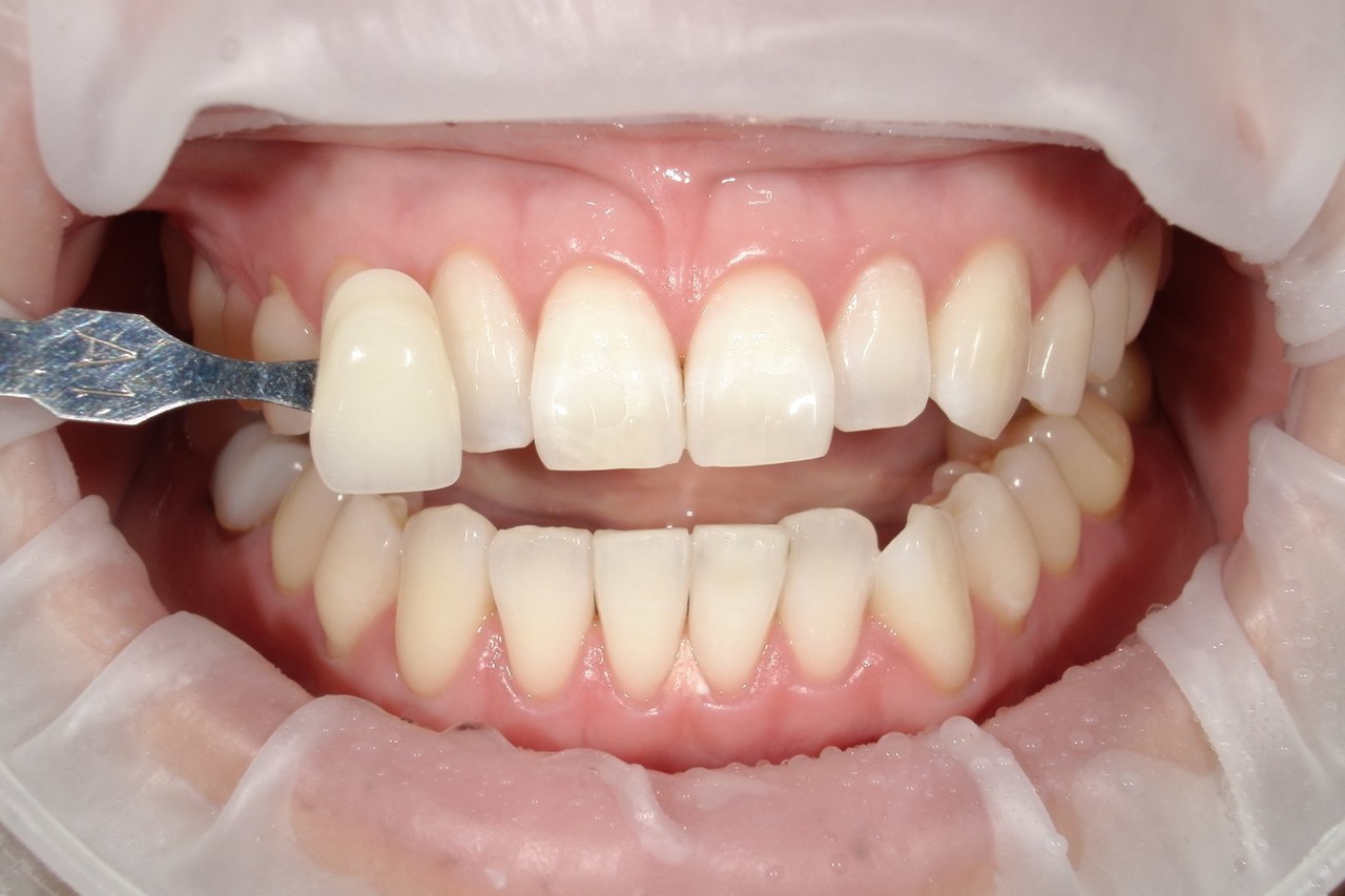 浜松市中央区・自動車学校前駅のホワイトニングの症例