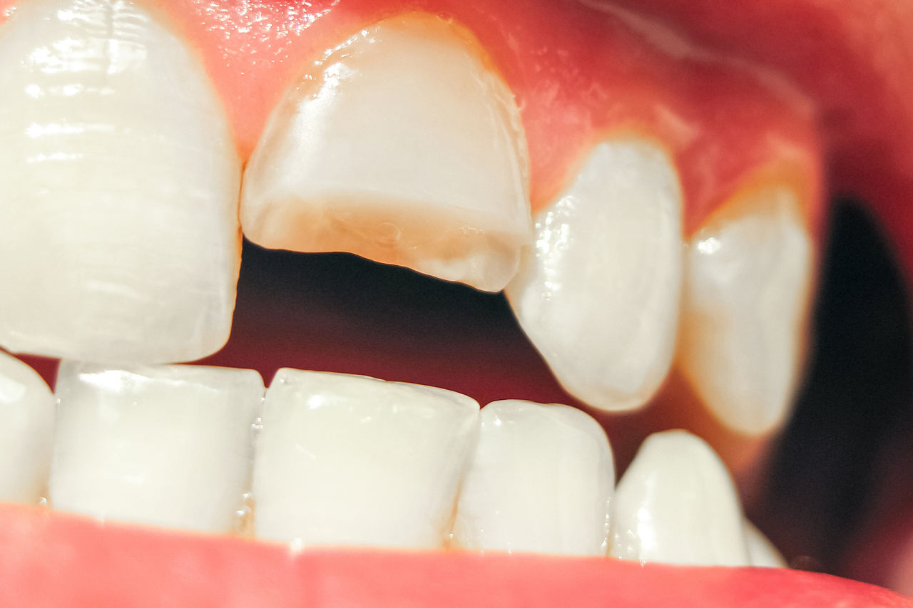 浜松市中央区・自動車学校前駅の歯ぎしり治療（ナイトガード）