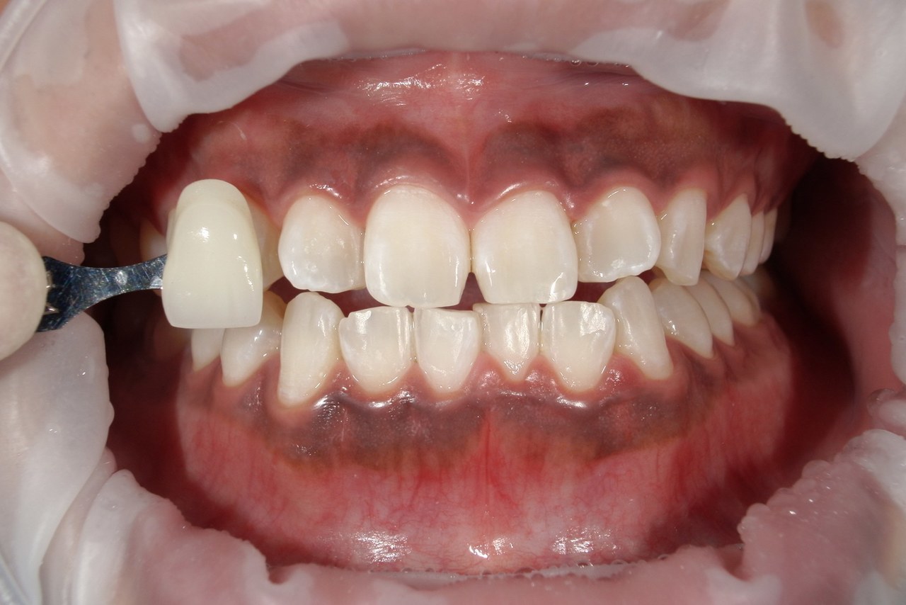 浜松市中央区・自動車学校前駅のホワイトニングの症例