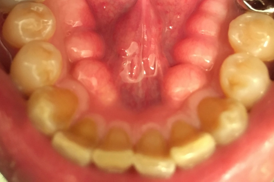 浜松市中央区・自動車学校前駅の歯ぎしり治療（ナイトガード）