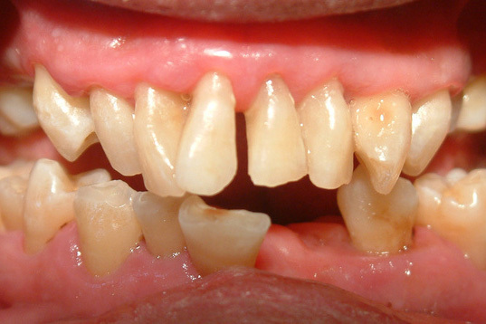 浜松市中央区・自動車学校前駅の歯ぎしり治療（ナイトガード）