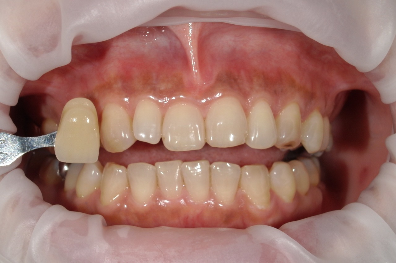 浜松市中央区・自動車学校前駅のホワイトニングの症例