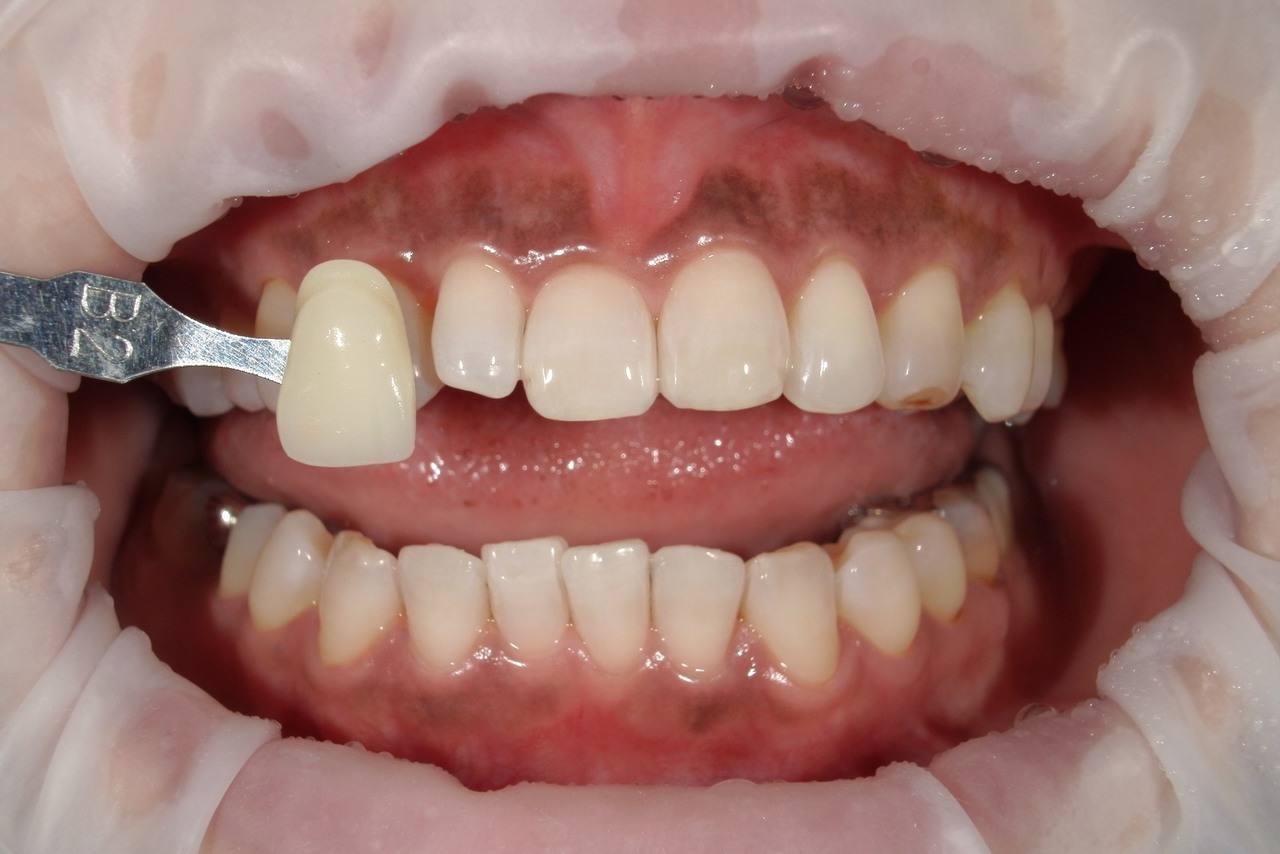 浜松市中央区・自動車学校前駅のホワイトニングの症例