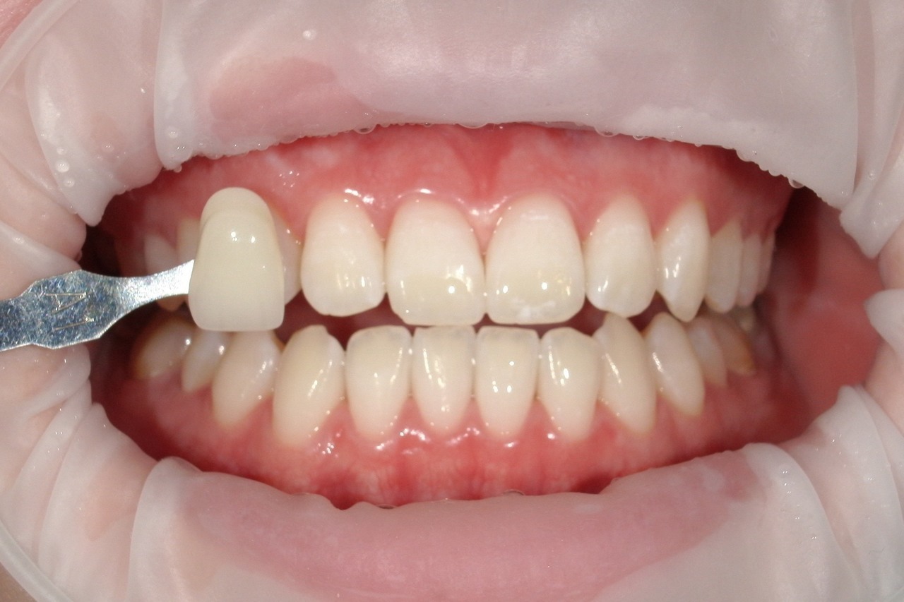 浜松市中央区・自動車学校前駅のホワイトニングの症例