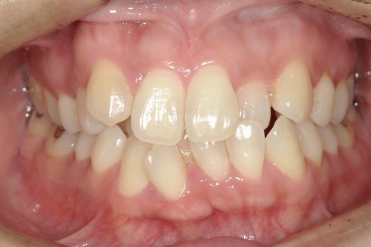 浜松市中央区・自動車学校前駅のインビザラインの症例