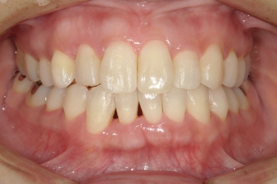 浜松市中央区・自動車学校前駅のインビザラインの症例