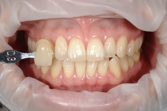 浜松市中央区・自動車学校前駅のホワイトニングの症例