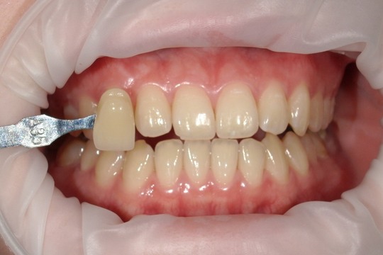 浜松市中央区・自動車学校前駅のホワイトニングの症例