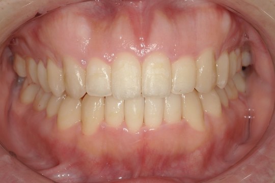 浜松市中央区・自動車学校前駅のインビザラインの症例