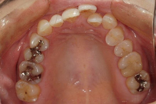 浜松市中央区・自動車学校前駅のインビザラインの症例