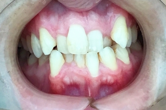 浜松市中央区・自動車学校前駅のインビザラインの症例