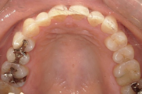 浜松市中央区・自動車学校前駅のインビザラインの症例