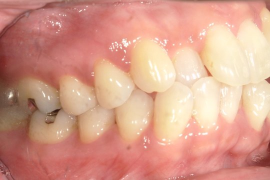 浜松市中央区・自動車学校前駅のインビザラインの症例