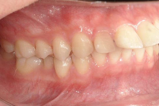 浜松市中央区・自動車学校前駅のインビザラインの症例