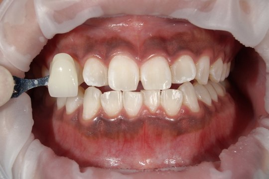 浜松市中央区・自動車学校前駅のホワイトニングの症例