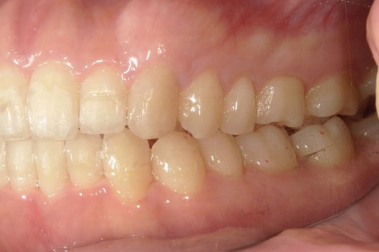 浜松市中央区・自動車学校前駅のインビザラインの症例