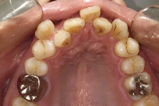 浜松市中央区・自動車学校前駅のインビザラインの症例