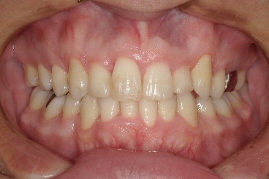 浜松市中央区・自動車学校前駅のインビザラインの症例