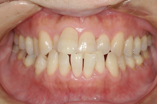 浜松市中央区・自動車学校前駅のインビザラインの症例