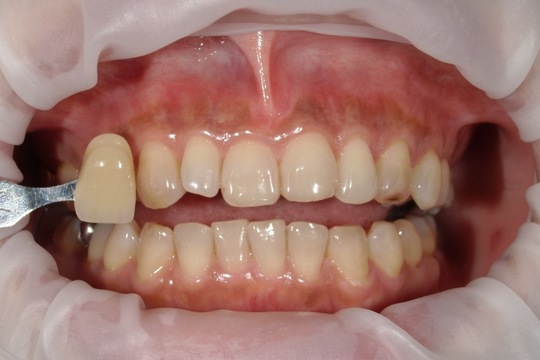 浜松市中央区・自動車学校前駅のホワイトニングの症例