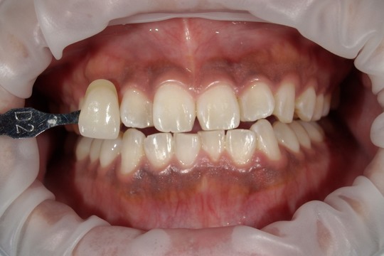 浜松市中央区・自動車学校前駅のホワイトニングの症例