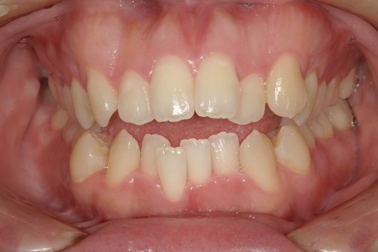 浜松市中央区・自動車学校前駅のインビザラインの症例