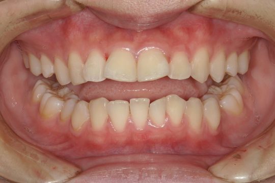 浜松市中央区・自動車学校前駅のインビザラインの症例