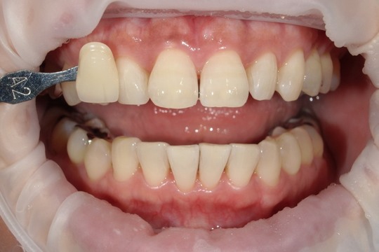 浜松市中央区・自動車学校前駅のホワイトニングの症例