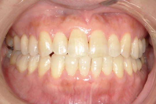 浜松市中央区・自動車学校前駅のインビザラインの症例