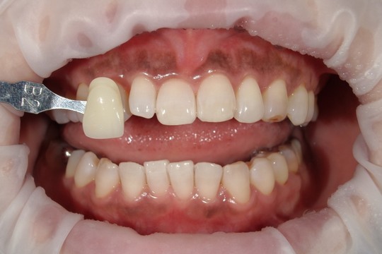 浜松市中央区・自動車学校前駅のホワイトニングの症例