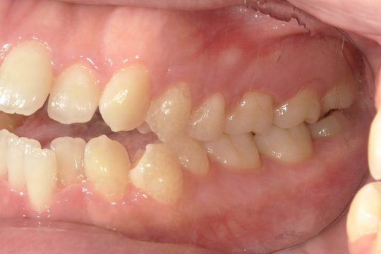 浜松市中央区・自動車学校前駅のインビザラインの症例