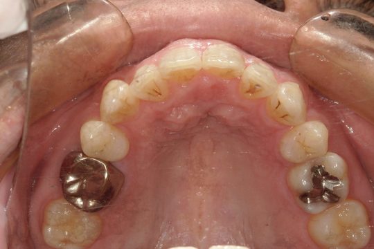 浜松市中央区・自動車学校前駅のインビザラインの症例