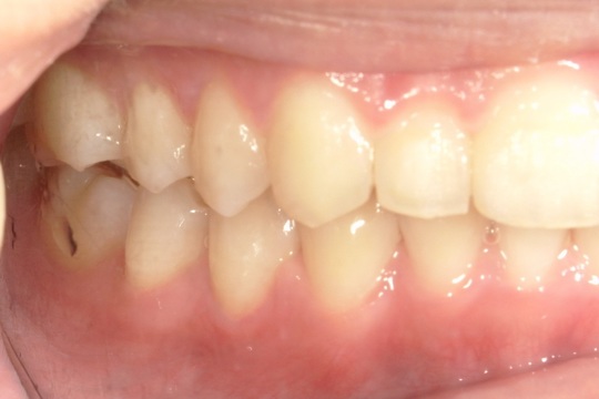 浜松市中央区・自動車学校前駅のインビザラインの症例