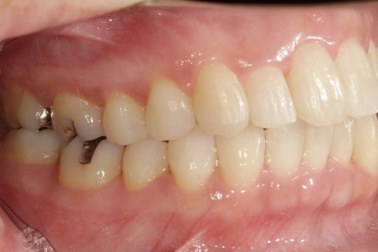 浜松市中央区・自動車学校前駅のインビザラインの症例