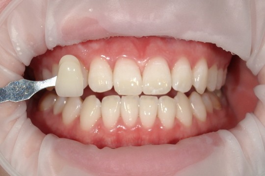 浜松市中央区・自動車学校前駅のホワイトニングの症例