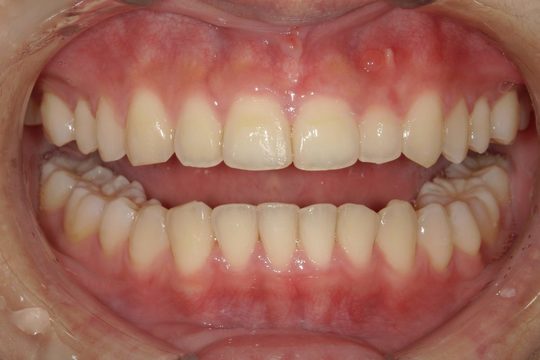 浜松市中央区・自動車学校前駅のインビザラインの症例